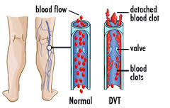 DEEP vein throbosis