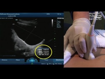 bladder ultrasound