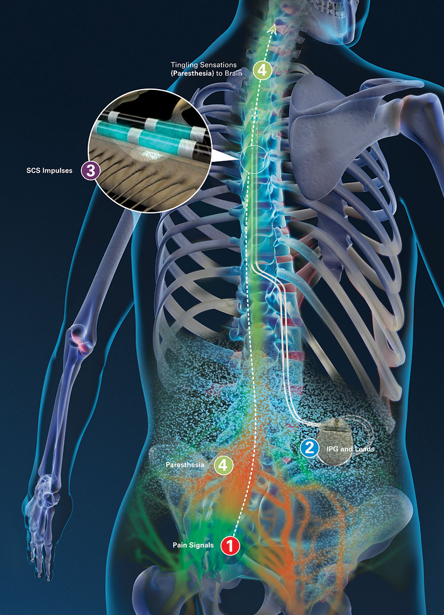 spinal cord stimulation